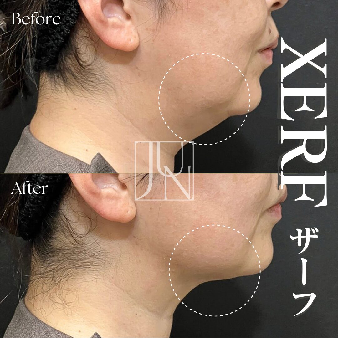 XERFザーフ