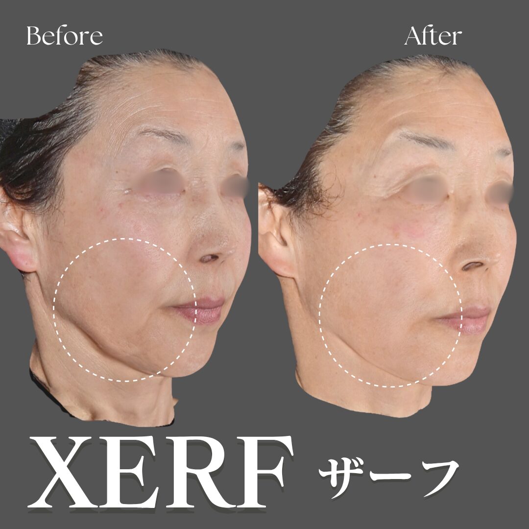 XERFザーフ