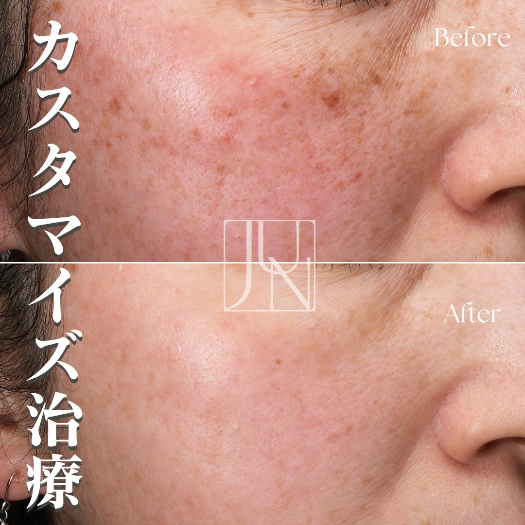 カスタマイズレーザー治療　50代シミ・赤み