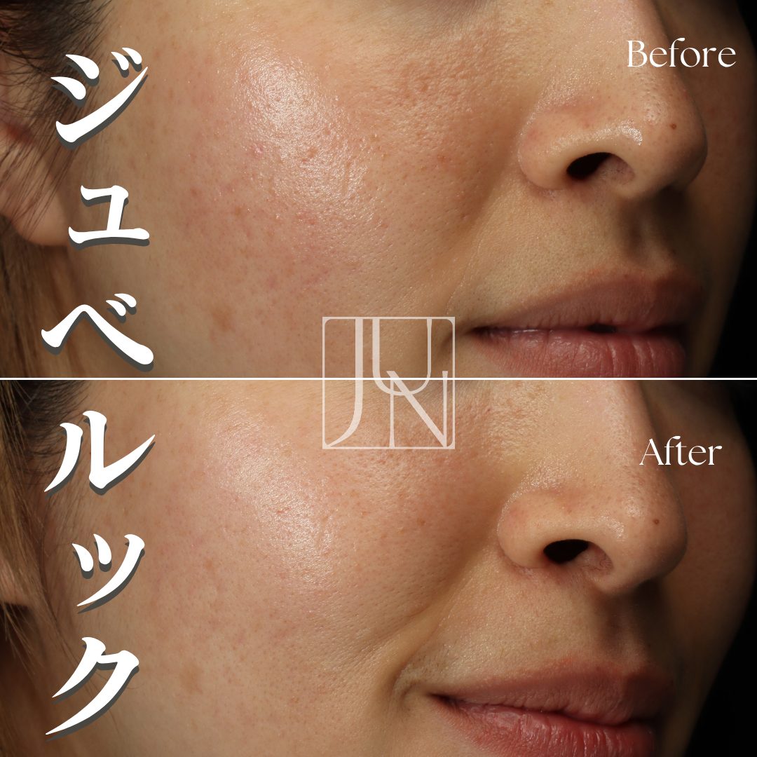 ジュベルック水光注射02　30代